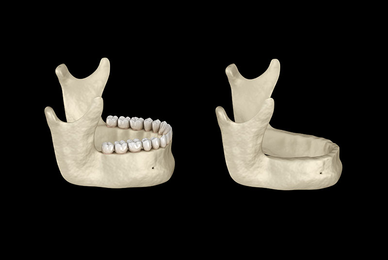 bone loss in jaw