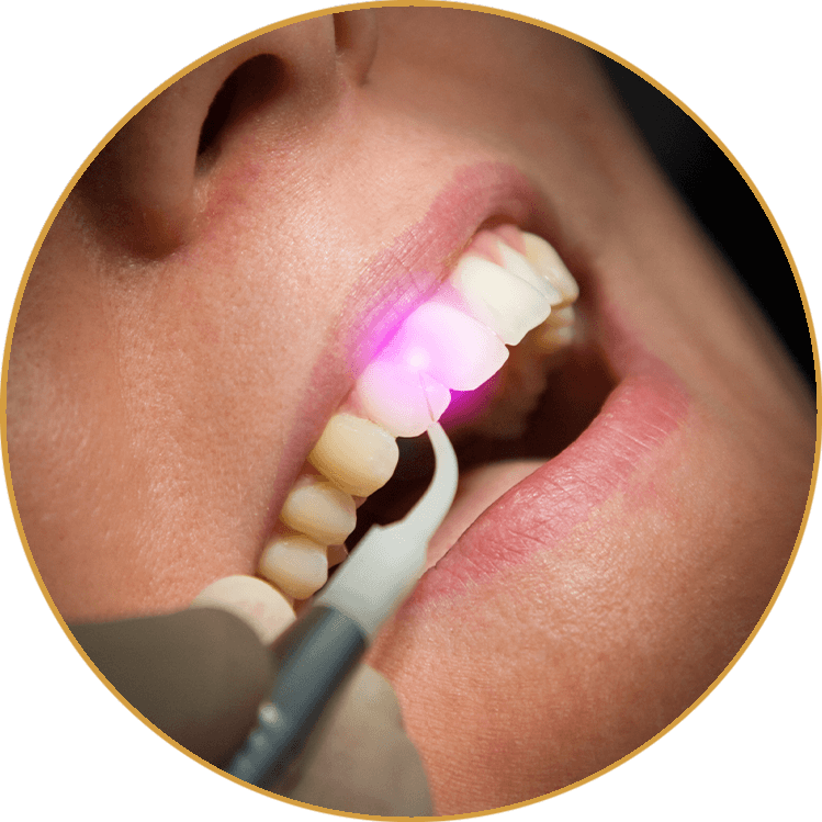 LANAP dental laser