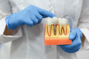 the hands of a dentist doctor hold a model of teeth with a dental implant